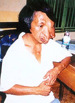 [250px-Agent-orange-deformities-vietnam.jpg]