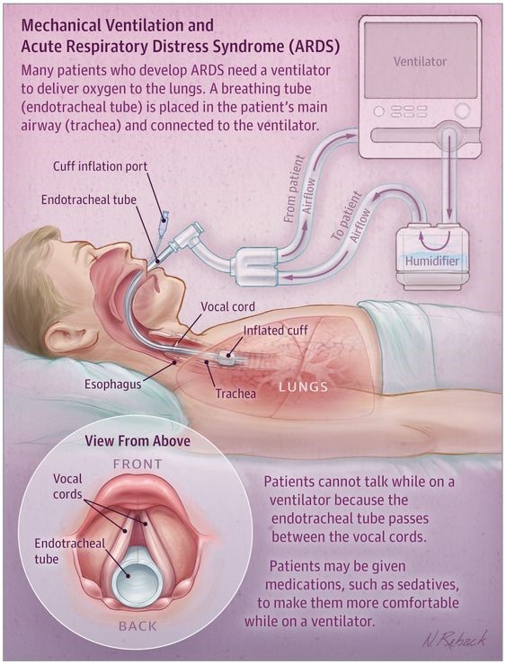 ventilator 1