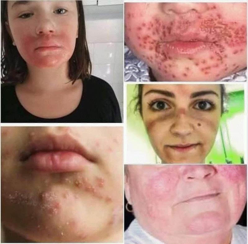 mask rash